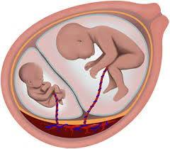 Song thai tiêu biến có thể phát hiện thông qua xét nghiệm nipt